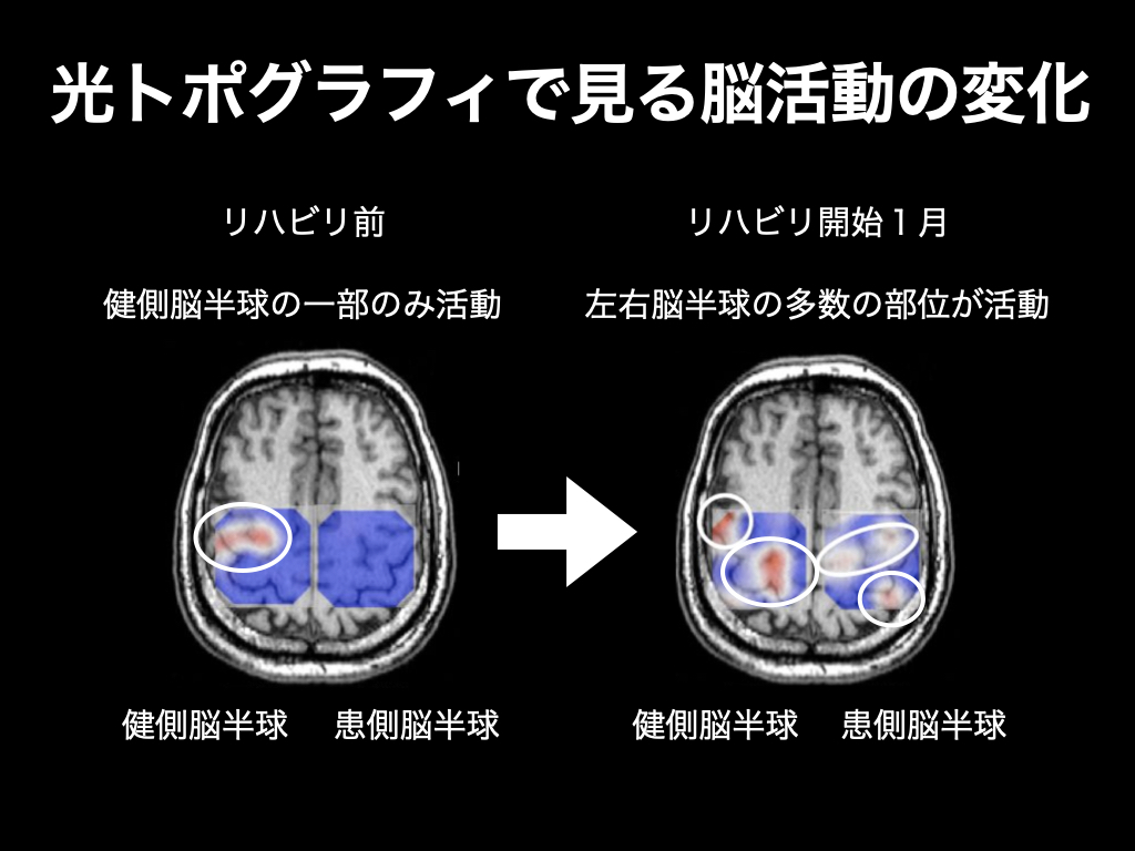 脳梗塞リハビリによる脳活動の変化